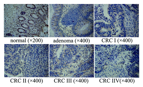 Figure 1.NPRL2 protein expression in normal colorectal tissue, adenoma and colorectal carcinoma of different histological grades (immunohistochemical staining × 400). Normal: +++, with 98% positive strongly staining; adenoma: ++, with 90% positive moderately staining; CRC I: ++, with 75% positive moderately staining; CRC II: +, with 45% positive moderately staining; CRC III: +, with 78% positive weakly staining; CRC IV: −, with 10% positive weakly staining.