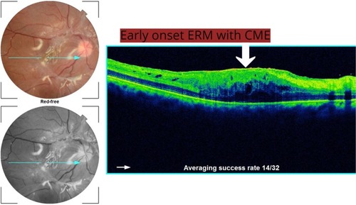 Figure 4 Early ERM ≤3 months with CME.