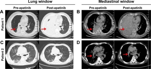 Figure 1 Representative CT images (lung windows and mediastinal windows) of two patients before and after apatinib monotherapy.