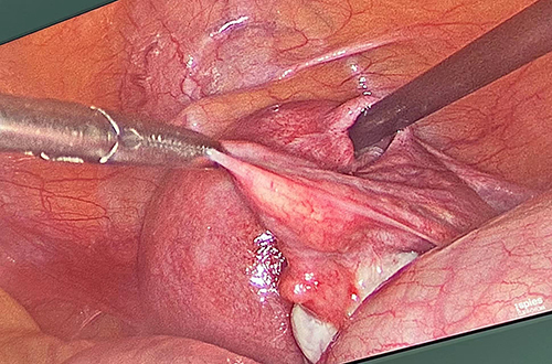 Figure 5 The right fallopian tube exhibits a normal appearance.