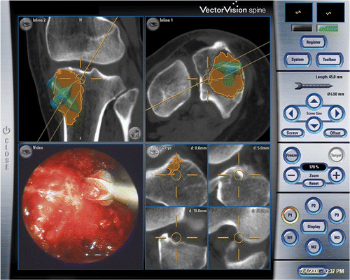 Figure 4. The tumor cavity and bone burring procedure could be directly visualized with the endoscope via small incision portal sites. The location of the navigated instrument tip (the orange circle) is shown with respect to reconstructed CT images. (The tumor is shaded in orange. The extrapolated orange line represents the direction of the instrument and is marked with 5-mm gradations, enabling it to be used to estimate the amount of bone removed and the risk of cortex perforation.)