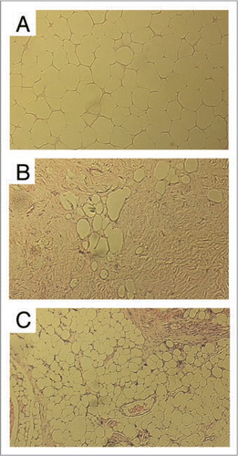 Figure 2 Histological examinations of encapsulated “fat grafts” after 4 months (H&E staining, original magnification ×400, Bars: 100 µm) show a well-retained fatty tissue structure in Group 1 (A, Top), large amount of tissue fibrosis with almost no maintained fatty tissue structure in Group 2 (B, Middle), and a reasonably well-retained fatty tissue structure associated with only minimal amount of tissue fibrosis in Group 3 (C, bottom) (Reprinted with permission from Pu LLQ, et al. The fate of cryopreserved adipose aspirates after in vivo transplantation. Aesthetic Surg J 2006; 26:9).