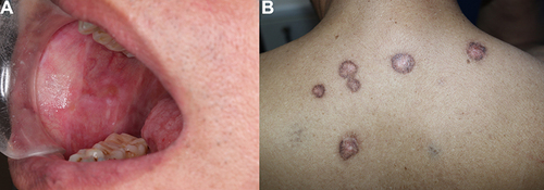 Figure 7 Improvement of PNP lesions of the oral mucosa (A) and DLE lesions of the upper back (B) after treatment.