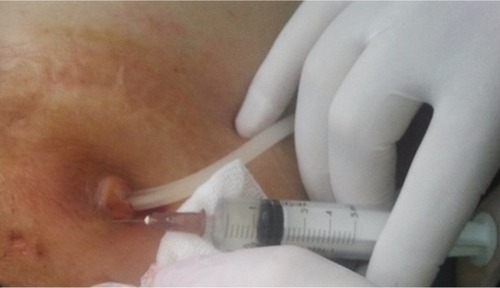 Figure 2 Application of subcutaneous gentamicin injection into the pericatheteral area in a PD patient with ESI.