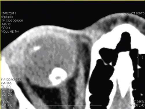 FIGURE 7  Orbital CT Scan - Calcifications of Posterior Granuloma and Ciliary Body.