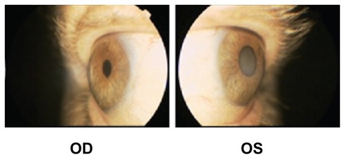 Figure 1 Anterior segment of the left and right eye (which underwent cataract surgery) showing the absence of the anterior chamber, observed during slit lamp examination, and choroidal congestion.