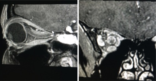 Figure 1 A typical appearance of a tubular optic nerve sheath meningioma on magnetic resonance imaging (gadolinium contrast-enhanced T1-weighted sequence with fat suppression). The tumor surrounds the nerve and shows the typical “tram track” appearance on the sagittal image with the hypointense optic nerve tissue lying between the enhancing tumor.