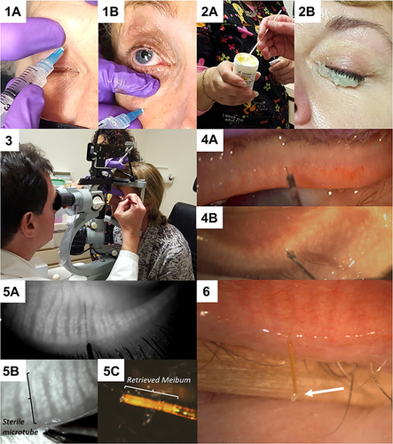 Figure 1 (1a and b) Performing supraorbital and infraorbital nerve block using JBP 33 gauge 4 mm long nanoneedles. (2a and b) Jojoba anesthetic ointment consisting of 8% lidocaine and 25% jojoba is taken from a refrigerated jar and applied to the lid margin for 10 minutes. This may be repeated. (3) The probing set-up at the slit lamp with an assistant to steady the patient for good visualization. (4) View through the slit lamp microscope of probing upper (a) and lower (b) lid Meibomian glands. (5) Meibography guided probing using the Mediworks S390L WDR FireFly Digital Slit Lamp from Eyefficient (Aurora, Ohio), demonstrating a 4 mm probe within the central duct (a), a sterile MicroTube Stent within the central duct for retrieval of meibum (b) and the retrieved meibum inside the MicroTube removed from within the gland (c). Reproduced from Maskin SL, Alluri S. Meibography guided intraductal meibomian gland probing using real-time infrared video feed. Br J Ophthalmol. 2020;104(12):1676; with permission from BMJ Publishing Group Ltd.Citation21 (6) An alternative approach to obtaining a virgin sample of meibum by allowing the meibum to travel through the MicroTube Stent for collection and analysis. Arrow shows a drop of meibum at the distal end of the MicroTube Stent.Citation22