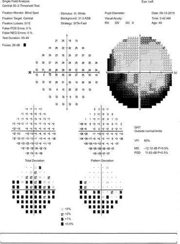 Figure 3 Humphrey visual field test showed improvement of visual field depression with residual inferior field defect of the left eye postoperatively.