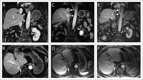 Figure 1. MRI of IVC Tumor Thrombus in clear cell RCC before and after SABR. Coronal (top) and axial (bottom) contrast enhanced MR images at different time points during the course of treatment. After nephrectomy and thrombectomy, the patient had an intraluminal recurrence of tumor thrombus, which was adherent to the IVC wall (arrowheads, A). The superior extent of the thrombus is inferior to the diaphragm (Level III; arrow, A). Note the size of the thrombus at the level of the right hepatic vein (arrow, B). After systemic targeted therapy (C) there was obvious disease progression with thrombus extending superior to the diaphragm (level IV, arrow) and increased enhancement (arrowhead, C). Note marked increased in transverse diameter (arrow, D). Two years after SABR therapy there is persistent thrombus extending above the diaphragm (arrow, E) although exhibiting clear decrease in enhancement (arrowhead, E) and marked reduction in transverse diameter (arrow, F).