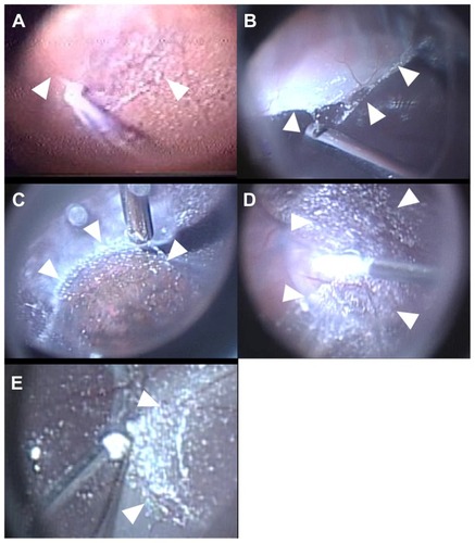 Figure 1 Intraoperative views of ocular contusion with a baseball. In all cases, a thin layer of localized vitreous adhesion (white arrowheads) was observed, overlapping the retinal degenerative areas, even after surgical posterior vitreous detachment. Triamcinolone acetonide was used to facilitate visualization of the vitreous and posterior hyaloid. (A) Case 1, (B) Case 2, (C) Case 3, (D) Case 4, (E) Case 5.