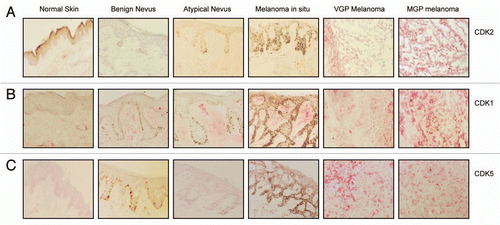 Figure 1 Expression of CDK2, CDK1, and CDK5 in the melanoma progression pathway. Five-µm sections, prepared from cryopreserved tissue specimens representing normal skin, benign nevus, atypical nevus, melanoma in situ and VGP and MGP melanoma were probed with antibody to (A) CDK2, (B) CDK1 or (C) CDK5 and counterstained with hematoxylin.