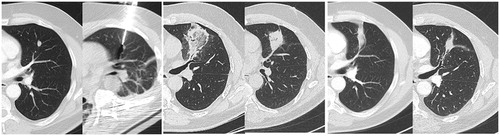 Figure 4. CT axial images. Evolution towards atelectasis of RFA scars in a 54-year-old patient, with secondary lesions of a liposarcoma.