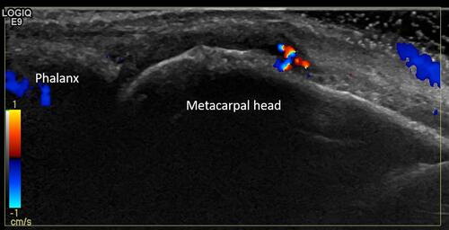 Figure 1 Patient with rheumatoid arthritis in clinical remission. The ultrasound image shows the third metacarpophalangeal joint with grade 2 synovial hypertrophy and grade 2 Doppler activity.
