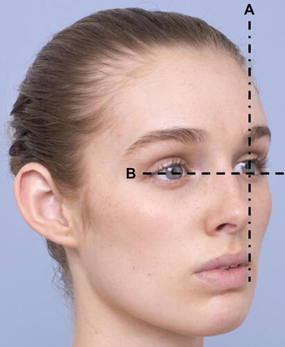 Figure 8 Shooting oblique view: (A) Align nasal tip to mid-pupil; (B) rotate head until all 4 canthi are visible. Note: Image courtesy of Woodrow Wilson.