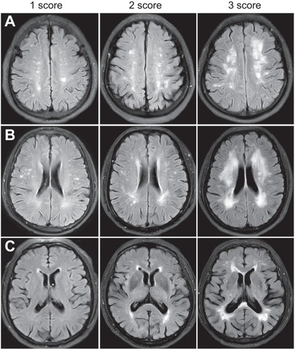 Figure 1 KIM score of white matter lesions. A, B, C, three layers of the brain (A=centrum semiovale, B=lateral ventricular body, C=basal ganglia); KIM score of each layer: 1 – small cap or thin lining lesion or punctuated lesion; 2 – larger cap or smooth halo lesion or more punctuated lesion with confluence; 3 – extending cap or irregular extended hyperintensity or lesion with massive confluence.