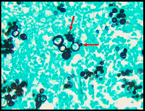 Figure 1 Histopathology of a granulomatous lesion due to PCM. Microphotograph of methenamine silver nitrate stain (Grocott-Gomori) demonstrating the peripheral budding yeast structures of P. brasiliensis, with the aspect of a pilot’s wheel, or “Mickey Mouse” head (red arrows).