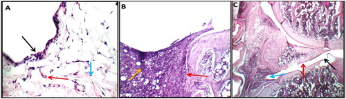 Figure 12. In control negative normal rats (a), higher power view showing average synovial lining with a single layer of flat synovial cells (black arrow) and intermediate sub-synovial connective tissue (blue arrow) and average blood vessels (red arrow) (H&E X 400). in control positive arthritic rats (B), high power view showing destructing pannus on and on menisci (red arrow) and a yellow arrow pointing to a sub-synovial inflammatory infiltrate (H&E X 200). in GTNc (C), showing small non-destructing pannus on articular cartilage (black arrow) and intact synovial lining (red arrow) with mild sub-synovial inflammatory infiltrate (blue arrow) (H&E X 200).