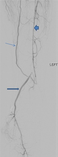 Figure 5 Lateral view from digital subtraction left lower extremity arteriogram demonstrates reconstitution of the posterior tibial artery (thick arrow) into the foot from a collateral vessel (thin arrow) and a diseased anterior tibial artery (block arrow).