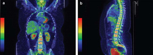 Figure 1. a. FDG-PET/CT (coronal section) showing lack of normal FDG-uptake in L IV in a patient with Hodgkin lymphoma after four courses of ABVD, indicating previous lymphoma involvement. b. Sagittal section from the same examination.
