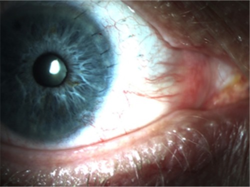 Figure 1 Anterior segment photograph of eye after cyclodialysis repair.