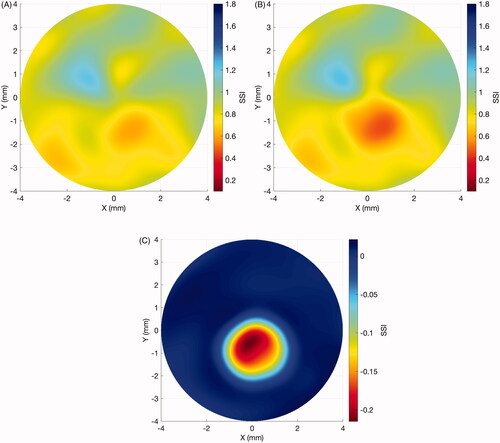 Figure 2. Case example of Stress-Strain Index (SSI) maps used in keratoconus progression. (A) Baseline SSI map exam. (B) SSI map after 25 months. (C) Differential map, showing the stiffness decrease mostly concentrated inside the cone area.