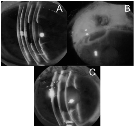 Figure 1 Case 1 was complicated by a shallow anterior chamber (A) because of bleb leakage with Seidel’s phenomenon (B). After corneal lamellar grafting, the anterior chamber had kept deep (C) and the IOP had also increased.