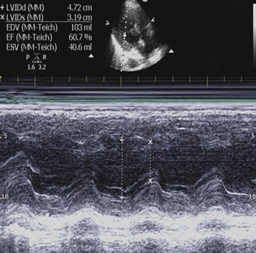 Figure 2 Echocardiographic screenshot of the heart.