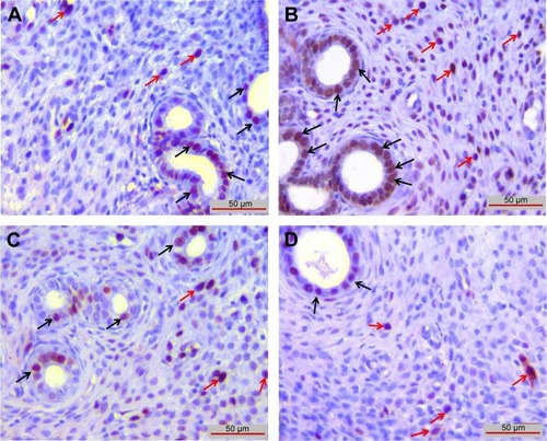 Figure 5 Ki-67 immunoreactivity was observed in endometrial stroma (red arrows) and endometrial glands (black arrows).