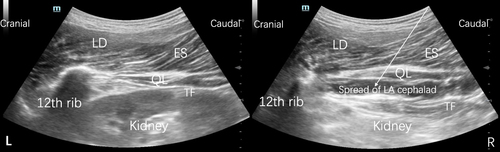 Figure 1 Sonography of SQLB before local anesthetic injection (L) and after local anesthetic injection (R).