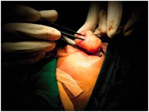 Figure 3. Excision biopsy of the exophytic mass.