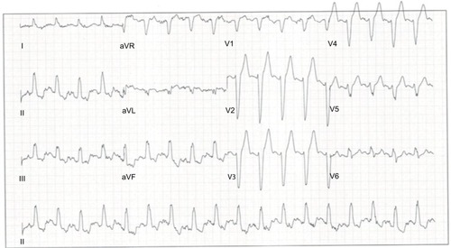 Figure 2 ECG (QRS 135 ms) demonstrating LBBB during stress before CRT.