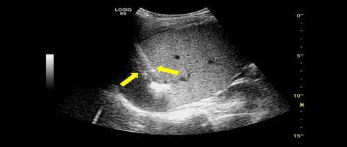 Figure 3 Ultrasound-guided microwave ablation was performed and electrodes were placed inside the tumor (arrow).