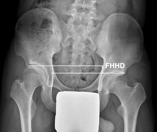 Figure 1. Measurement of femoral head height difference (FHHD) on standing anteroposterior radiograph of the hip.