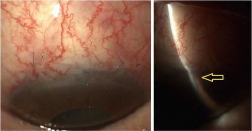 Figure 1 Slit-lamp images depicting the status after trabeculectomy and phacoemulsification before the onset of bullous keratopathy. Note the iridocorneal contact at the slit beam (yellow arrow).