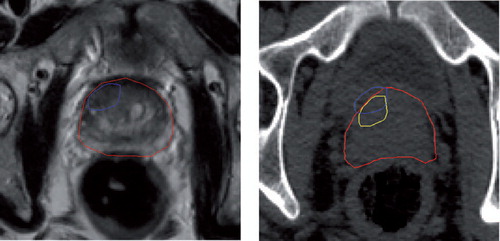 Figure 2. Left: Section of a T2-weighted MR image showing the prostate (red) and focal lesion (blue). Right: Section of the planning CT image with prostate (red) and rigidly registered focal contour (blue), which lies outside of the prostate volume. The result of non-rigidly registering the focal lesion (yellow) using the same deformation pattern that the prostate has undergone between MR and CT acquisition places the focal lesion inside the prostate.