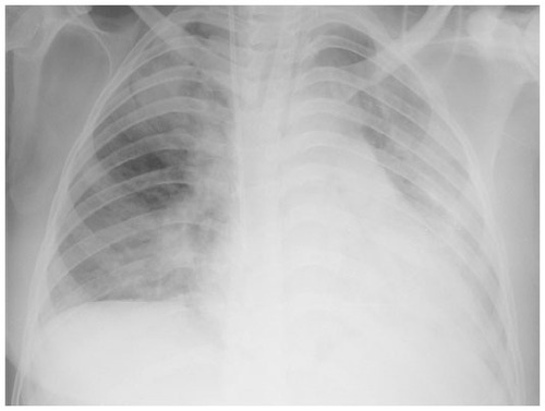 Figure 1 Chest radiography after the transfusion, revealing newly developed diffuse bilateral lung infiltrations in mostly both whole lungs.