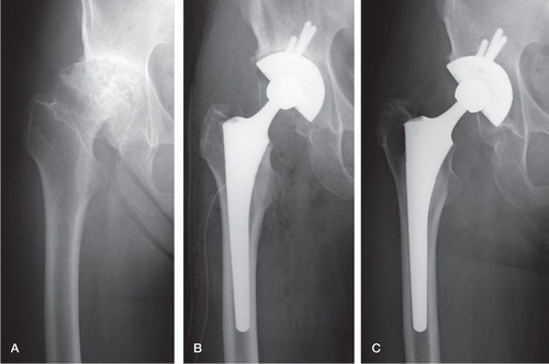 Figure 2. A 60-year-old woman with secondary osteoarthritis of the right hip. A. The preoperative Merle d’Aubigné and Postel score was 10 points. B. AW-GC bottom-coated acetabular and femoral components were implanted. C. The Merle d’Aubigné and Postel score improved to 16 points, and bone ingrowth fixation was achieved 9 years after surgery.