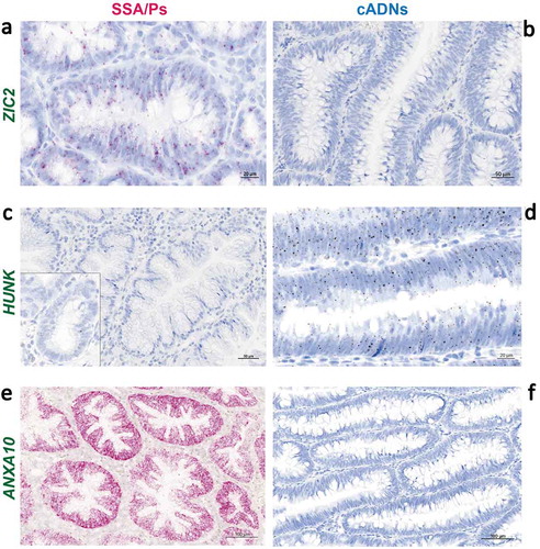 Figure 5. In situ hybridization analysis of ZIC2, HUNK, and ANXA10 mRNAs in SSA/Ps and cADNs. ZIC2 expression (red punctate labeling) is (a) present in SSA/Ps and (b) absent in cADNs. HUNK (brown punctate labeling) is (c) almost absent in SSA/Ps (very low-level expression was present at the bottom of serrated crypts, see inset) and (d) expressed in cADNs. Control staining for ANXA10, a known SSA/P-specific marker[Citation25,Citation73–Citation75] was (e) strongly positive in SSA/Ps (dense red punctate labeling) and (f) absent in cADNs.