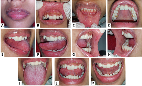 Figure 3 Improvement of the oral lesion on the 10th day (A–K).