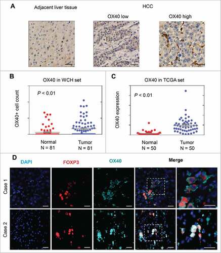 Figure 1. OX40 is differentially expressed in HCC and adjacent liver tissues. (A) Immunohistochemical staining showing higher OX40 expression in HCC than adjacent liver tissues. (Scale bars: 50 μm) (B) Scatter plot showing more OX40 positive cell counts in HCC than adjacent liver tissue from the WCH set; the Y-axis is the number of OX40 positive cells. (C) Scatter plot showing the higher OX40 mRNA level in HCC than in adjacent liver tissue in the TCGA set; the Y-axis is the OX40 mRNA expression measured by RNA sequencing. (D) Three-color immunofluorescence microscopy was used to analyze the distribution of tumor-infiltrating Tregs expressing OX40. Representative images from two cases showing the expression of OX40 (cyan) on FOXP3+ (red) T cells. (Scale bars: 20 μm).