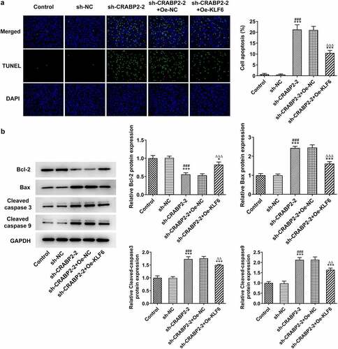 Figure 6. KLF16 overexpression reverses the effects of CRABP2 knockdown on apoptosis of RB cells. (a) The apoptosis of WERI-RB1 transfected with sh-CRABP2-2 and Oe-KLF16 was analyzed by Tunel assay. (b) The expression of apoptosis related proteins (Bcl-2, Bax, cleaved-caspase 3 and cleaved-caspase 9) in WERI-RB1 transfected with sh-CRABP2-2 and Oe-KLF16 was determined by Western blot. *P < 0.05 and ***P < 0.001 vs. control group. ###P < 0.001 vs. sh-NC group. ∆∆P < 0.01 and ∆∆∆P < 0.001 vs. sh-CRABP2-2+ Oe-NC group.