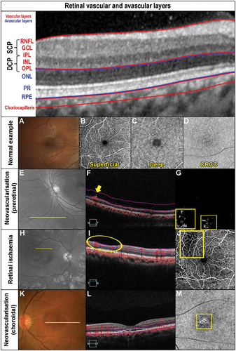 Figure 1. Retinal vasculature and anomalies evident when using OCT-A and other imaging modalities. The OCT b-scan image is separated into various slabs: the inner vascular regions incorporating the superficial (SCP) and deep capillary plexus (DCP: red region), followed by the avascular region (blue) and finally the vascular (red) choriocapillaris. The SCP within the superior vascular slab extends from the ILM to the posterior IPL while the DCP extends from the posterior IPL to the anterior ONL. Only the SCP and DCP are shown as per CIRRUS OCT nomenclature. There is an intermediate capillary plexus that straddles the SCP and DCP which some OCT instruments include. (A) Fundus photograph of a healthy right eye. OCT-A imaging of the (B) superficial capillary plexus showing the foveal avascular zone, (C) deep (deep capillary plexus) and (D) outer retina to choriocapillaris (ORCC) of a normal eye. (E) Red-free image of a patient with proliferative diabetic retinopathy in the left eye. The yellow line shows the location of the OCT b-scan derived from the OCT-A cube. (F) OCT b-scan shows the neovascularisation located pre-retinally (yellow arrow). The vitreoretinal interface slab lines are defined by the pink dashed lines. (G) VRI (vitreoretinal interface) OCT-A image shows two regions of neovascularisation (yellow boxes). (H) Red-free image of a patient with a history of proliferative diabetic retinopathy managed with peripheral pan-retinal photocoagulation in the right eye. The yellow line shows the location of the OCT b-scan derived from the OCT-A cube. (I) OCT b-scan shows focal inner retinal thinning temporally (yellow oval). (J) The focal inner retinal thinning corresponds to a region of reduced capillary density (yellow box) on the superficial OCT-A image. (K) Fundus photograph of a patient with acute central serous chorioretinopathy and associated pachychoroid neovasculopathy in the left eye. The yellow line shows the location of the OCT b-scan derived from the OCT-A cube. (L) OCT b-scan shows subretinal fluid overlying a flat irregular pigment epithelial detachment (FIPED). (M) ORCC OCT-A image shows a neovascular network centrally (yellow box) displaying a bright vascular network surrounded by a duller region before continuing to a normally appearance for the ORCC. (N) Abbreviations: superficial and deep capillary plexus (SCP and DCP); RNFL – retinal nerve fibre layer; GCL – ganglion cell layer; IPL – inner plexiform layer; INL – inner nuclear layer; OPL – outer plexiform layer; ONL – outer nuclear layer; PR – inner and outer segments of photoreceptor layer; RPE – retinal pigment epithelium.