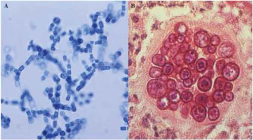Figure 2. Mycelia containing arthroconidia and a mature spherule with endospores. (a) Mature mycelia grown in vitro showing darkly stained arthroconidia alternating with a nucleate thin walled segments within mycelia (lacto-phenol cotton blue stain). (b) A spherule containing endospores in tissue (Periodic Acid Schiff (PAS)). The images were obtained from the CDC (http://phil.cdc.gov/phil/details.asp). This figure was previously published in the Journal of Fungi [Citation70].
