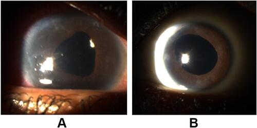 Figure 3 Postoperative anterior segment photos of the (A) right and (B) left eye.