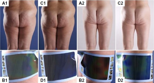 Figure 3 Treatment of two patients (1, 2) with cellulite using radial extracorporeal shock wave therapy.