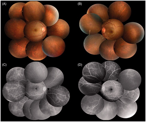 Figure 2. Fundus photographs and fluorescence angiograms at recurrence a few weeks after delivery. (A, B) Fundus photographs of both eyes at a few weeks after delivery. Intensive vitreous opacities in the right eye were decreased and almost clear in both eyes. (C, D) Fluorescein angiography of both eyes. Fluorescene angiography detected peripheral retinal vasculitis and nonperfusion areas in both eyes.