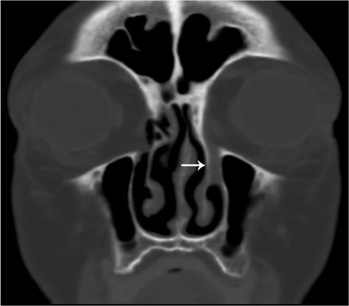 Figure 4 Coronal image illustrating an opacified nasolacrimal duct (arrow). Notes: Due to patient rotation, the contralateral duct cannot be viewed in this frame.