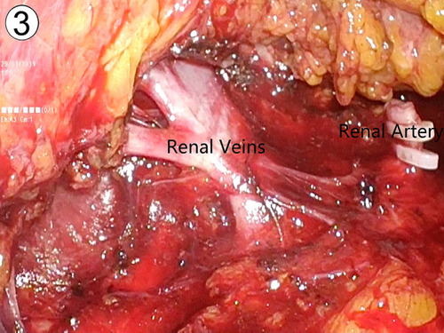 Figure 3 Dissection of renal pedicle through retroperitoneal approach. By dissecting the surrounding tissues of the kidney along the psoas muscle, the posterior surface of the kidney was reflected medially. Then renal pedicle was identified with dissection of the renal artery and vein.