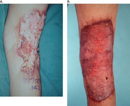 Figure 3. (A) Post-burn scar verrucous carcinoma of the popliteal area; (B) after wide excision and skin grafting. Recurrence and inguinal lymph node metastasis 2 years later.